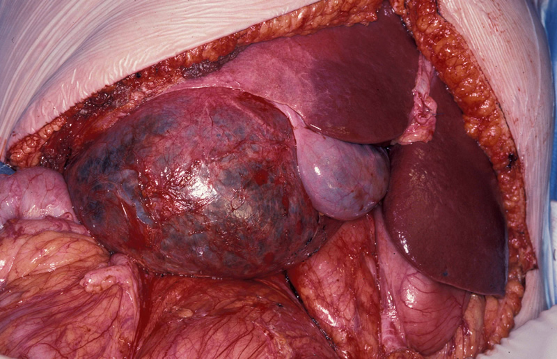 What causes liver cysts?