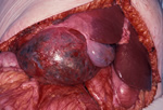 Massive liver cyst 