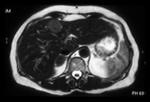 An MRI scan showing a solitary secondary deposit